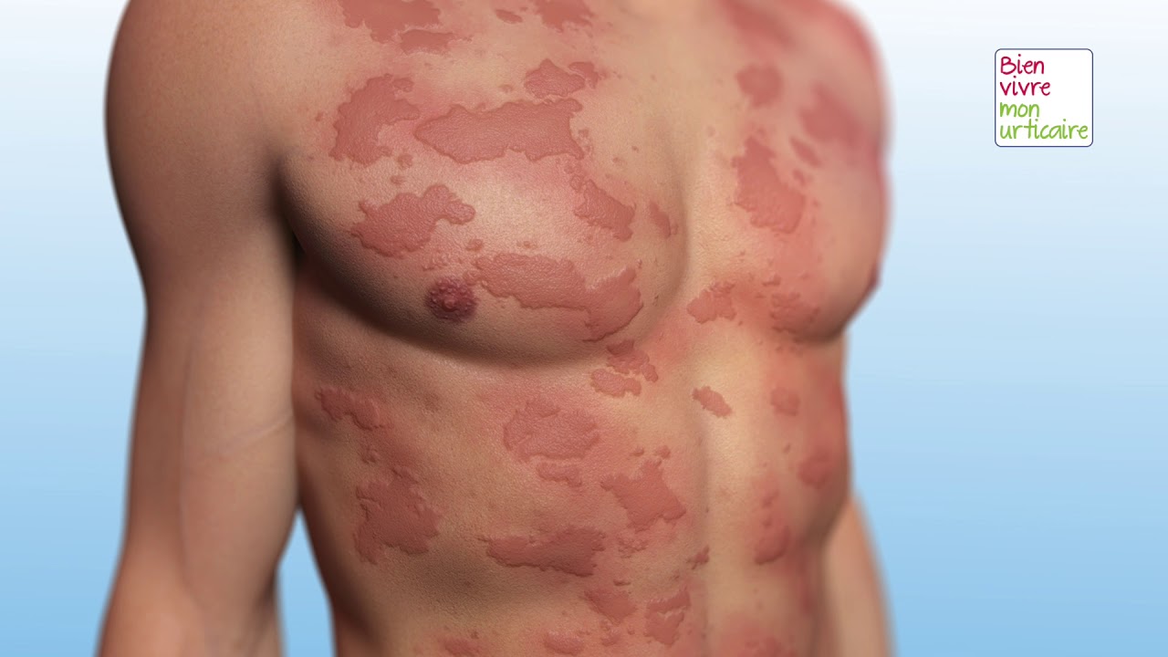 Urticaire et allergie. Quelles sont les différences ?